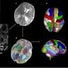 Isso mostra imagens do cérebro no período perinatal destacando áreas relacionadas ao autismo